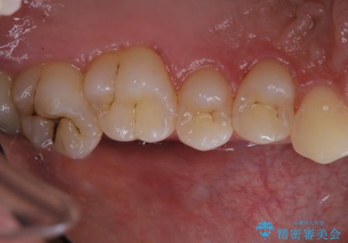 タバコによる着色をPMTCできれいな白い歯にの治療後