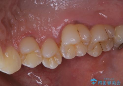 タバコによる着色をPMTCできれいな白い歯にの治療後