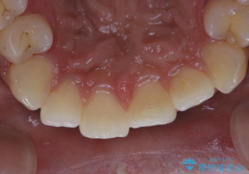 タバコによる着色をPMTCできれいな白い歯にの治療後