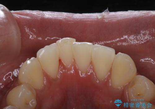 タバコによる着色をPMTCできれいな白い歯にの症例 治療後