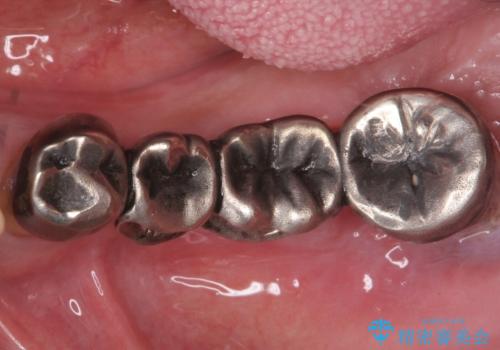 歯がぐらぐらで咬めない　奥歯のインプラント　50代男性の症例 治療前