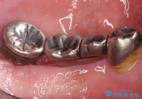 歯がぐらぐらで咬めない 奥歯のインプラント 50代男性の治療前