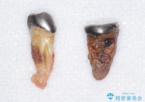 歯がぐらぐらで咬めない 奥歯のインプラント 50代男性の治療前