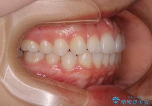 前歯のがたつきをインビザラインで治療の治療後