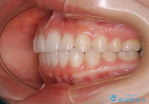 前歯のがたつきをインビザラインで治療の治療後