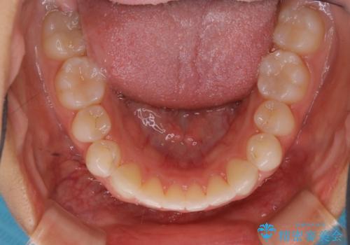 前歯のがたつきをインビザラインで治療の治療後