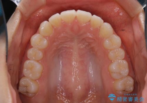 前歯のがたつきをインビザラインで治療の治療後