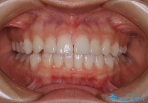 前歯のがたつきをインビザラインで治療の治療中