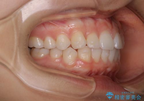 前歯のがたつきをインビザラインで治療の治療中