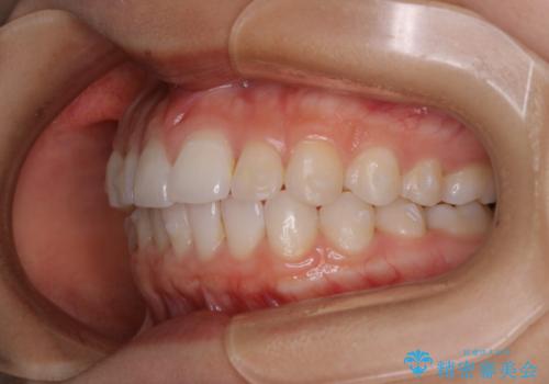 前歯のがたつきをインビザラインで治療の治療中