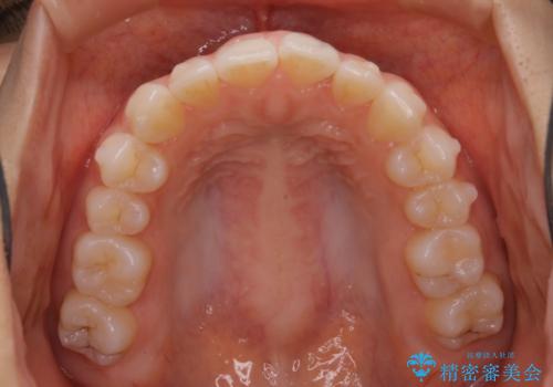 前歯のがたつきをインビザラインで治療の治療中