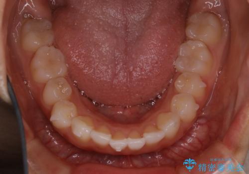 前歯のがたつきをインビザラインで治療の治療中