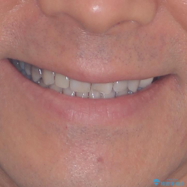 下の歯が前に出てしまう咬み合わせを治したい　インビザラインによる矯正治療の治療後（顔貌）