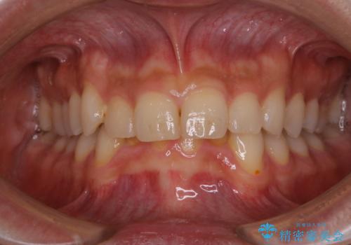 5・6年ぶりに歯のクリーニングの治療前