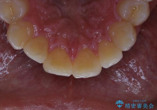 5・6年ぶりに歯のクリーニングの治療前