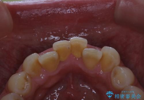 5・6年ぶりに歯のクリーニングの治療前