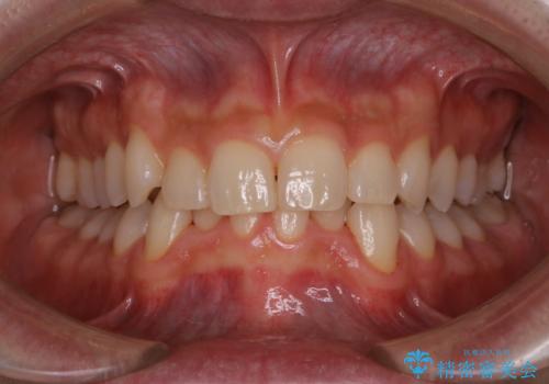 5・6年ぶりに歯のクリーニングの治療後