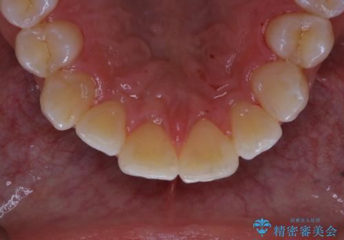 5・6年ぶりに歯のクリーニングの治療後