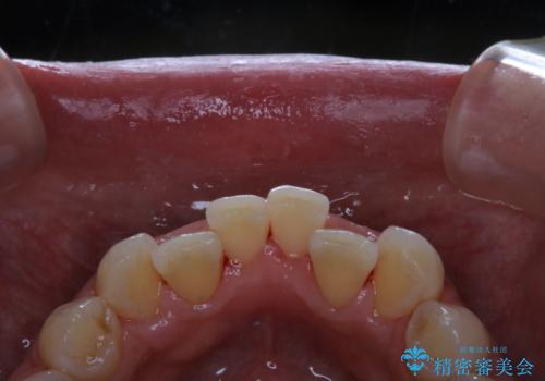 5・6年ぶりに歯のクリーニングの治療後