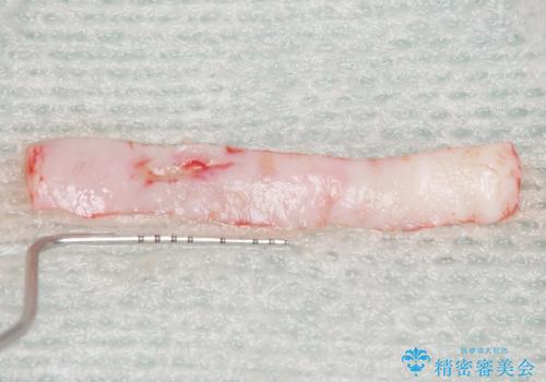 歯肉移植(FGG)による角化歯肉の獲得で長持ちするインプラントへ 50代男性