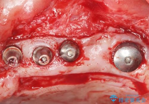 歯肉移植(FGG)による角化歯肉の獲得で長持ちするインプラントへ 50代男性の治療中