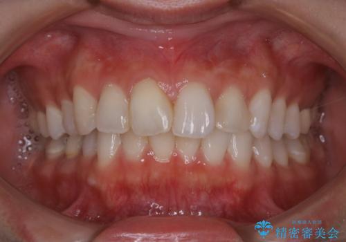 ホワイトニングで白くしたいの治療前