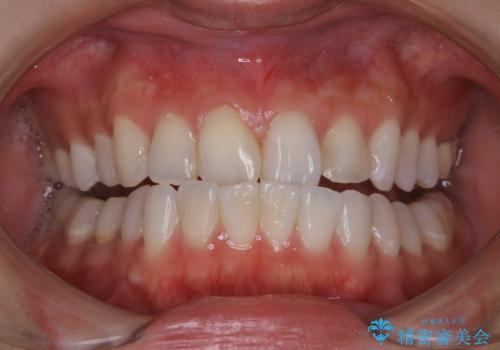 ホワイトニングで白くしたいの治療前