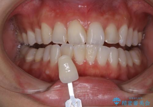 ホワイトニングで白くしたいの治療前