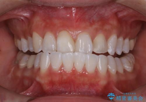 ホワイトニングで白くしたいの治療後