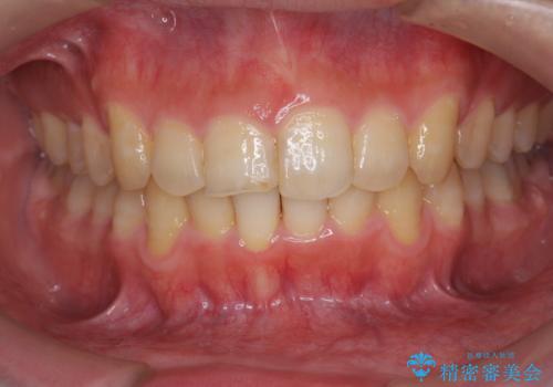[ インビザライン ] マウスピース矯正で治す出っ歯の治療の症例 治療後