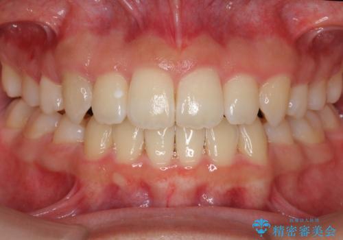 インビザラインチェンジで成功　インビザラインで八重歯の抜歯矯正の症例 治療後