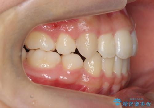 インビザラインチェンジで成功　インビザラインで八重歯の抜歯矯正の治療後