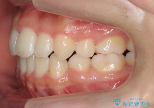 インビザラインチェンジで成功　インビザラインで八重歯の抜歯矯正の治療後