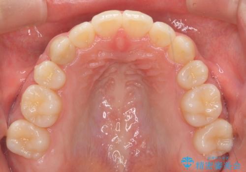 インビザラインチェンジで成功 インビザラインで八重歯の抜歯矯正の治療後