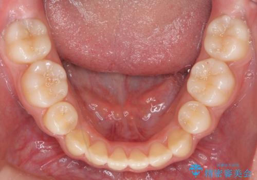 インビザラインチェンジで成功 インビザラインで八重歯の抜歯矯正の治療後
