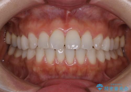 数年ぶりに歯のクリーニングの治療前