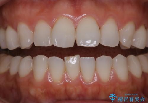 数年ぶりに歯のクリーニングの治療前