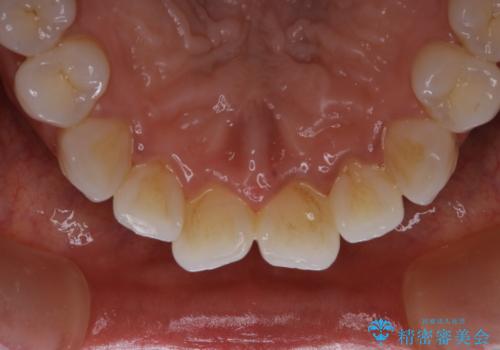 数年ぶりに歯のクリーニングの治療前