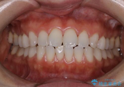 数年ぶりに歯のクリーニングの治療後