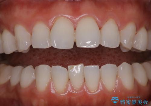 数年ぶりに歯のクリーニングの治療後