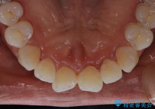 数年ぶりに歯のクリーニングの治療後