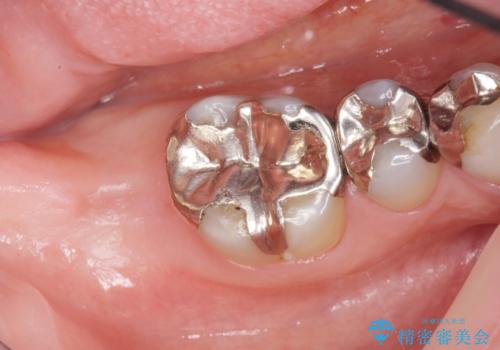 低価格でしっかりとしたインプラント治療 30代男性の治療前