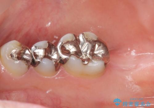 低価格でしっかりとしたインプラント治療 30代男性の治療前