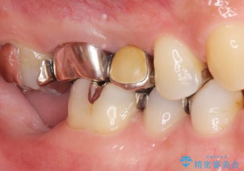 低価格でしっかりとしたインプラント治療 30代男性の治療前