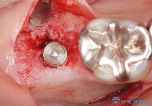 低価格でしっかりとしたインプラント治療 30代男性の治療中