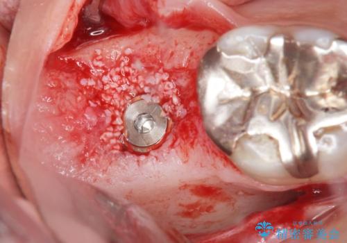 低価格でしっかりとしたインプラント治療 30代男性