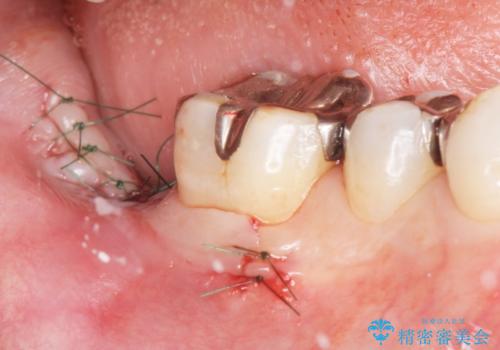 低価格でしっかりとしたインプラント治療 30代男性の治療中