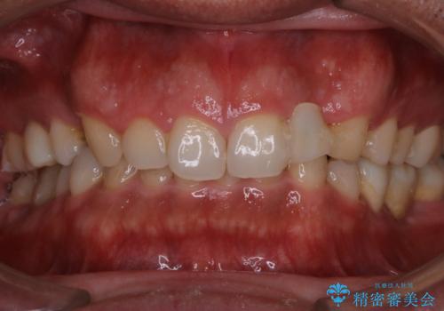 前歯のステインを取りたい PMTCできれいにの治療前