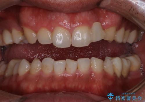 前歯のステインを取りたい　PMTCできれいにの症例 治療前