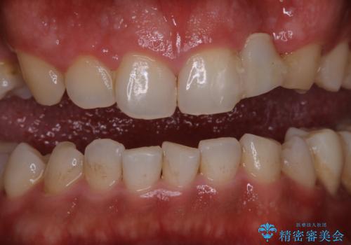 前歯のステインを取りたい PMTCできれいにの治療前